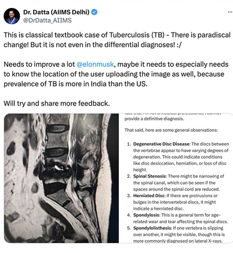 spinal tuberculosis