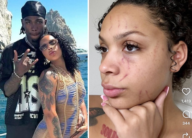 Photo of Dacoda Jones injuries