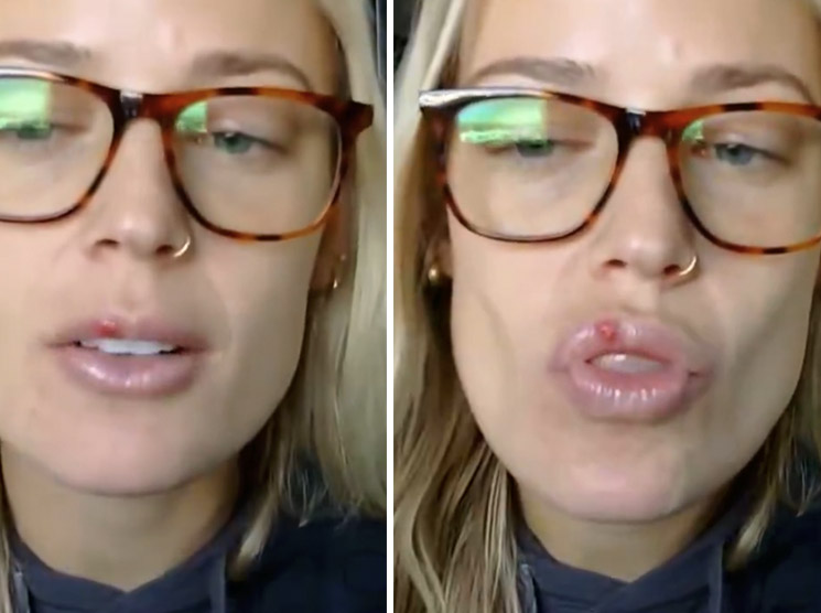 Photo of Sophie Cunningham's cold sore