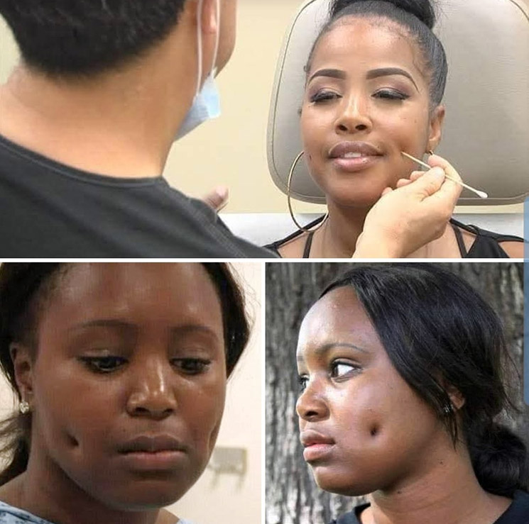 Photo of dimpleplasty procedure