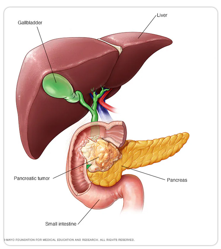 Graphic of tumor in the head of the pancreas