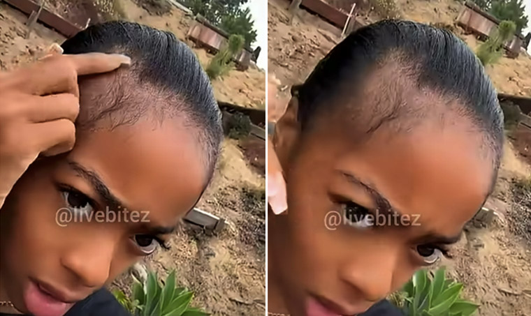 Skai Jackson opens up about postpartum hair loss