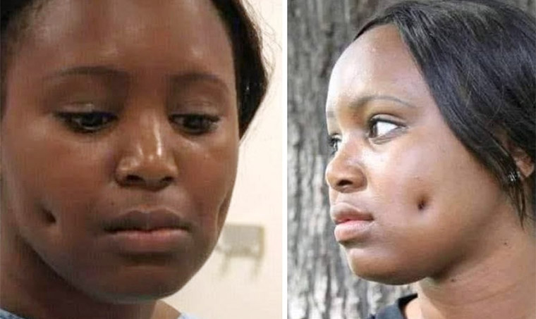 Dimple Surgery Takes the Internet By Storm